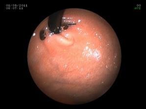Safestich gastroplastica 2 éves kontroll: subjectiv panasz csökkent - 2/5 beteg teljesen panaszmentes PPI igény csökkent - 3/5 beteg gyógyszerigénye csökkent - 2/5 beteg a PPI-t elhagyta 208 redo