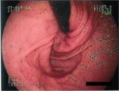 felett F: fundoplicatio F0: ép fundoplicatio F1a: részleges disruptio F1b: teljes disruptio
