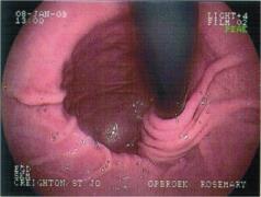 F2b: two-compartment stomach F1a F1b E, S, F, P komponensek E: GEJ és rekeszszárak viszonya