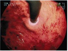 Surg Endosc 2014;28(4):1103-1109.