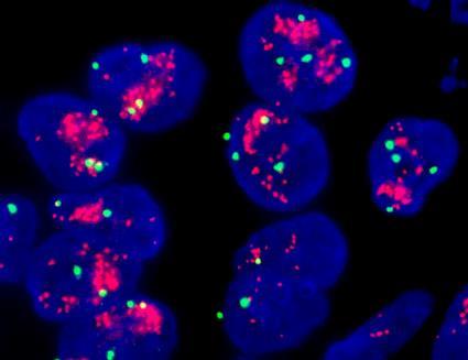 A növekedési factor receptorok overexpressioja Her2/Neu (17q22) high amplification Gyakoribb, mint a mutáció Génamplificatio következtében példák: ERBB1 (EGF receptor gén): Túlexpressalt a tüdő SCC-k