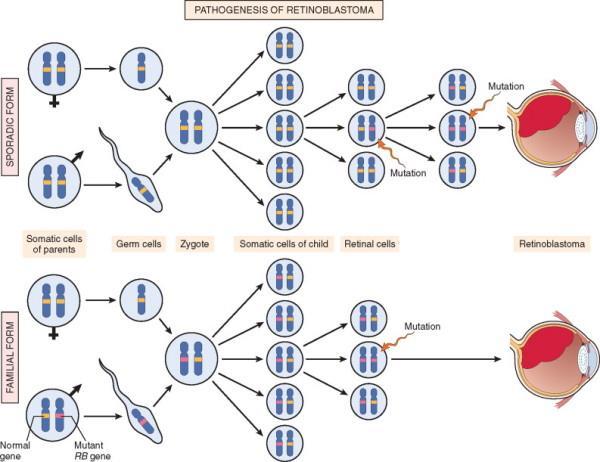 RETINOBLASTOMA GÉN (RB) RB gén, az első tumor suppressor gén, a 13q14 locuson, először retinoblastomában írták le Retinoblastoma: a szem retinájából indul ki