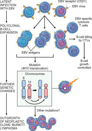 EBV (Epstein-Barr Virus) Burkitt lymphoma High grade/agressive B-cell lymphoma A leggyakoribb tumor a gyermekkorban