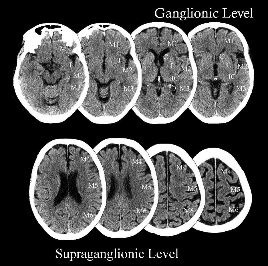 ASPECTS (Alberta Stroke Program Early CT Score) Korai ischémiás jelek keresése 10 meghatározott régióban -Nucl.