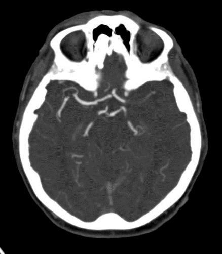 Nagyér elzáródás - iv thrombolysis proximális nagyér elzáródásban (ICA,