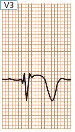 Subepicardiális ischemia Subepicardiális ischemia Ischémiás terület