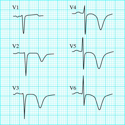 Instabil angina pectoris