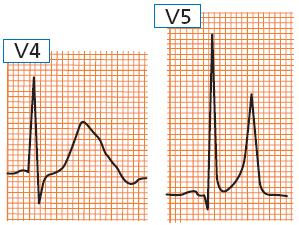 Bevezetés az EKG analízisbe IV. Myocardiális ischemia, sérülés és nekrózis.  Prof. Szabó Gyula SZTE ÁOK Kórélettani Intézet - PDF Free Download