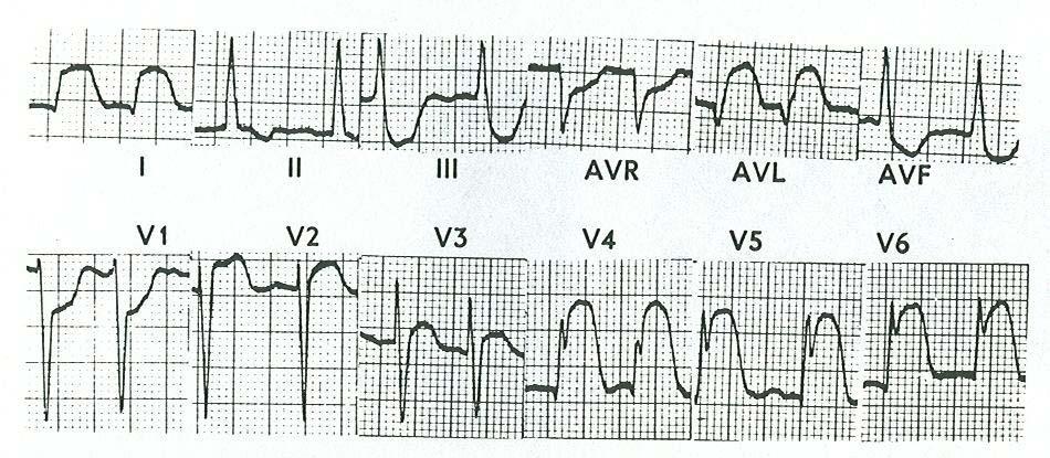 Anterolaterális STEMI ST I,