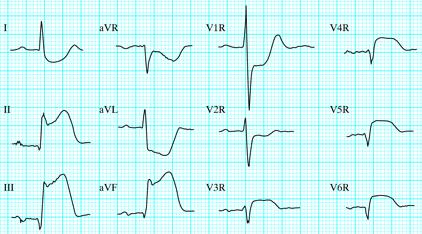 Akut inferior & jobb kamrai STEMI ST