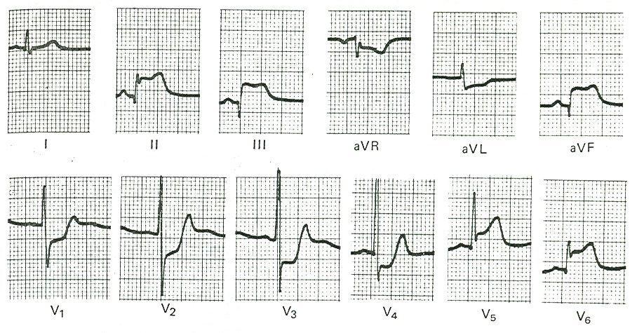 Inferolaterális STEMI ST II III ST (II,III,