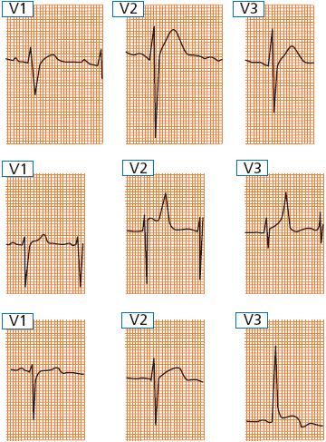 Akut pericarditis