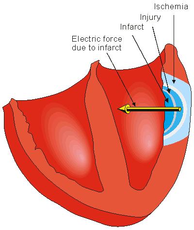 Myocardiális nekrózis Infarktus Pathológiás Q hullám kialakulása Ischémia Sérülés Ischemia ST szakasz depresszió, T hullám inverzióval vagy anélkül Sérülés 1.