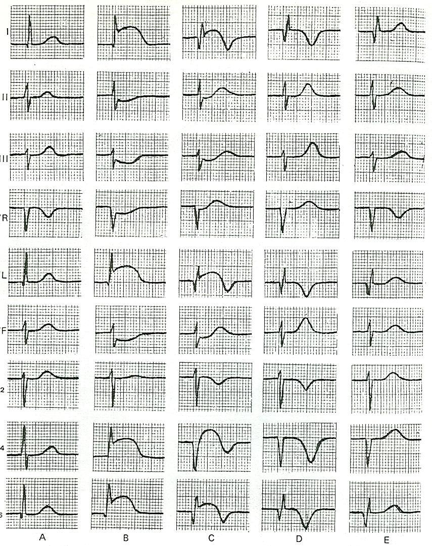 I II III avr avl avf V1-2 V3-4 V5-6