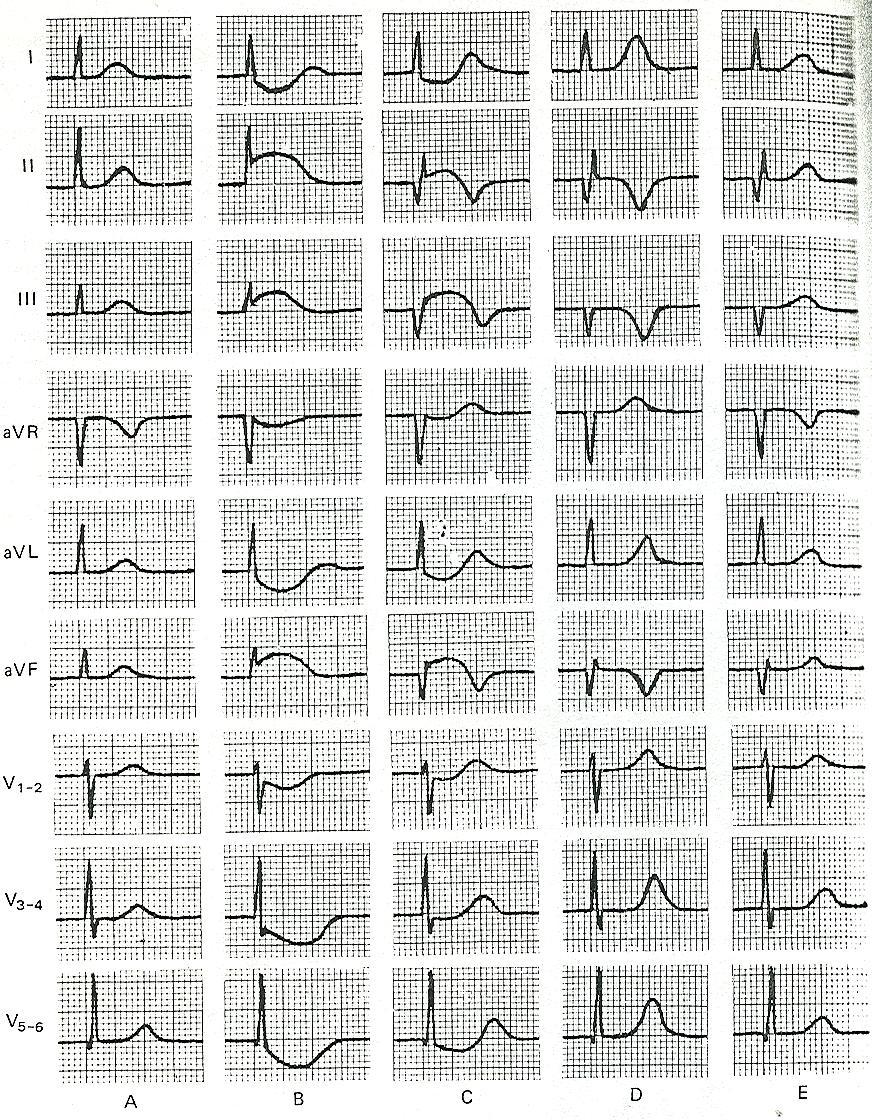 Normális STEMI Q