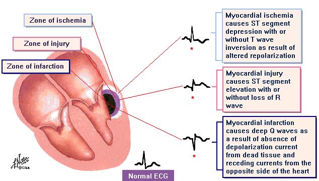 Ischemia Sérülés Nekrózis Myocardiális ischemia T hullám inverzióval és ST változással vagy nélküle Myocardiális sérülés ST