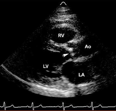 21. ábra: Aorta stenosis echokardiográfiás képe http://www.medscape.com/viewarticle/456334_3 Egy, a balkamrai kifolyótraktusról parasternális hossztengelyi metszetben készült kép.