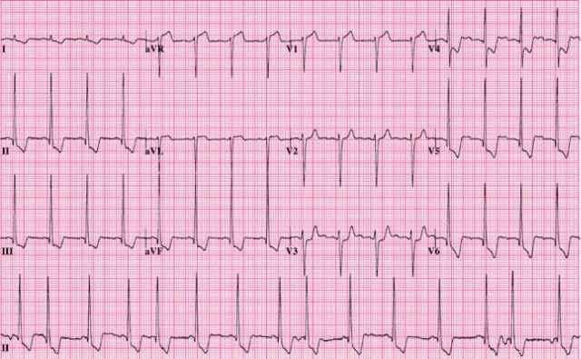 23. ábra: Hypertrophiás obstructiv cardiomyopathia http://www.edexam.com.