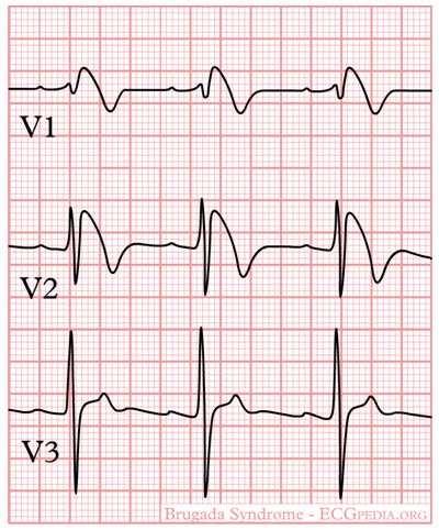 V4-6-ban ST depresszió, negatív T hullámok 24. ábra: Brugada syndroma.