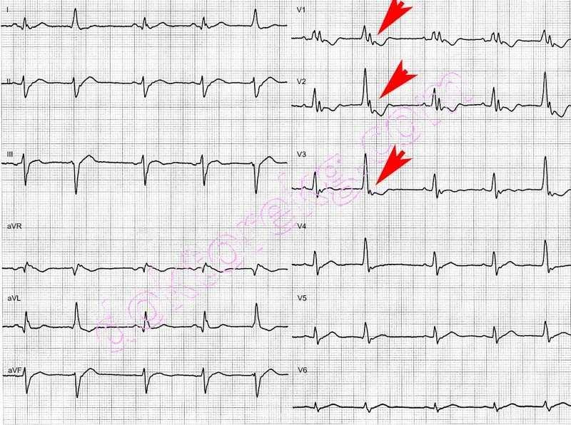25. ábra. Jobb kamrai arrhythmogén dysplasia (ARVD). Epsilon hullám a QRS komplexum után V1, V2, V3-ban. http://pages.mrotte.