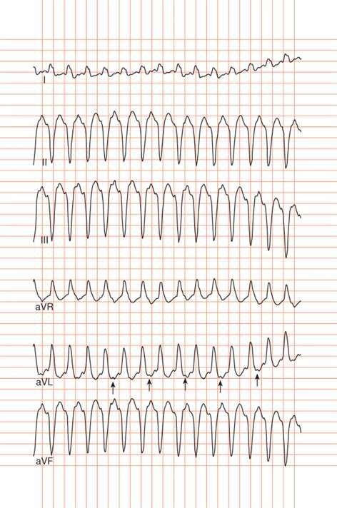 26. ábra: Balszárblokk típusú kamrai tachycardia. http://www.tankonyvtar.