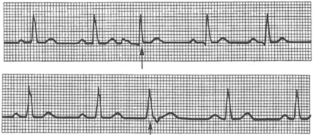 Cardialis decompensatio EKG jelei Sinus tachycardia, repolarizációs zavar (lapos negatív vagy bifázisos T hullám, pitvari és kamrai polimorf extrasystolék előfordulhatnak SI, SII-ben PQ megnyúlás