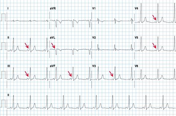 deviáció és inkomplett vagy komplett bal szárblokk társul hozzá. Supraventricularis tachycardia gyakran alakul ki, ilyenkor a P: 180-250/min. (34.