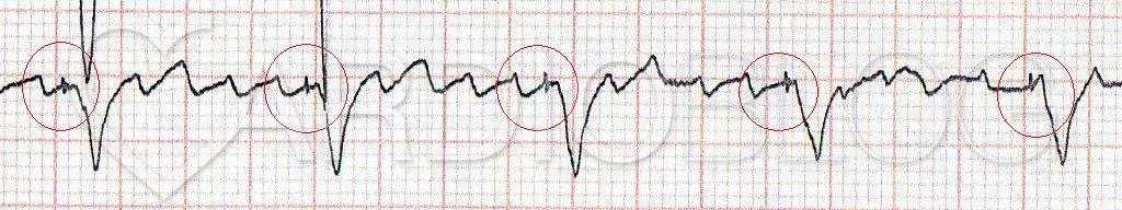 36. ábra: Pitvari fluttern http://www.cardioblog.hu/ekg-rejtvenyek/v-nyari-elso-feladvany/ Fűrészfogszerű P hullámok.