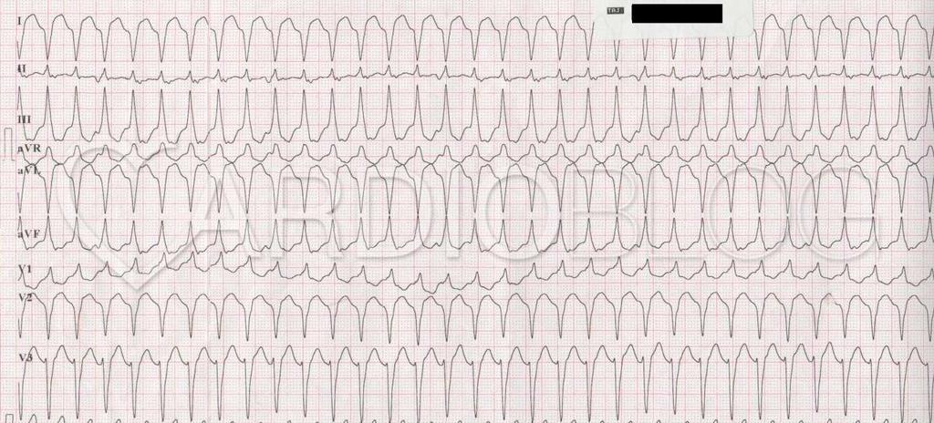 A kamrára általában AVblockkal vezetődik át a pitvari ingerület (F-hullám). 37. ábra: Ventricularis tachycardia http://www.cardioblog.