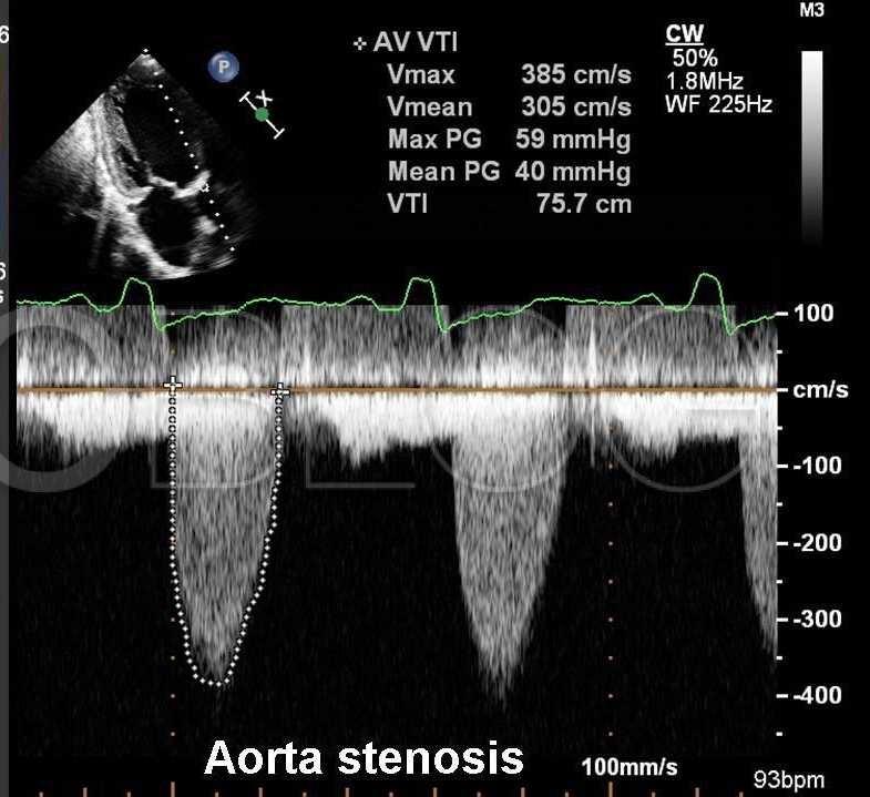 43. ábra: Folyamatos Doppler vizsgálat (CWD) aorta stenosisban http://www.cardioblog.