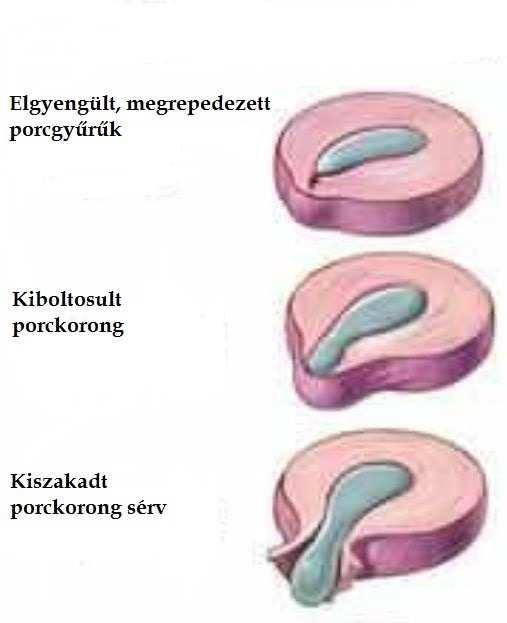 Megelőzés Szimmetrikus hátizom-erősítés (gerinctorna), helyes sportági technika, megfelelő felszerelés (derékrögzítő). 44. ábra: Porckorongsérv kialakulása és MRI képe III.5.