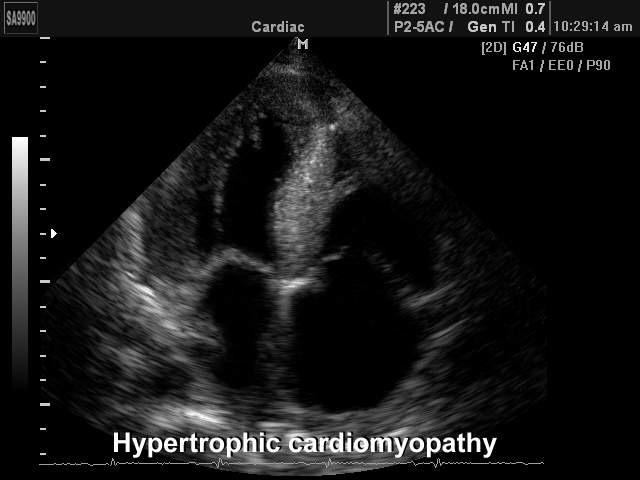kizárható az sem, hogy az aritmián kívül a nagyfokú hypertrophia az aorta eredésének dinamikus obstrukciója miatt is okozhat hirtelen szívhalált. 20.