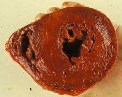 com/post/117724329311/cardiomyopathy Aritmogén jobb kamrai cardiomyopathia A hypertrophiás cardiomyopathián kívül egyéb rendellenességeket is összefüggésbe hoztak a hirtelen sportolói szívhalállal.