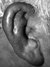 Külső fül gyulladásai Perichondritis - Sérülés, műtét, furunculus mellett jelentkező porc és porchártya gyulladás - A fertőzés a porc és a porchártya közt hatol előre ( a porc a porchártya felöl
