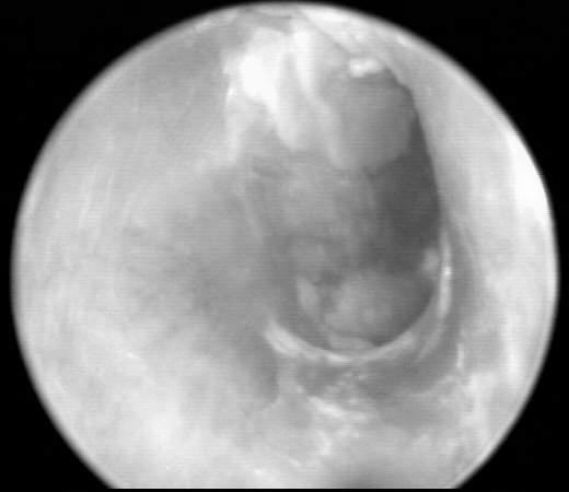 Otitis externa Külső hallójárat gyulladása Szűk elszarusodó laphám üreg, testmeleg.
