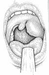Tonsillitis acuta Komplikációk: Peritonsillaris abscessus Az angina lezajlását követően, több napos tünetmentes szak után gyorsan fokozódó nyelési fájdalom> fülbe sugárzik Szájzár, gombócos beszéd.