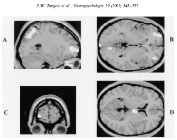 Fokozott bal inferior frontál gyrus aktivitás a felidézett szavakra Prospektív emlékezet és kérgi aktivitás (PET) Br. 10 Miért felejtünk?