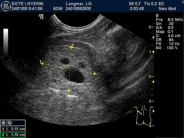 INTRAABDOMINALIS