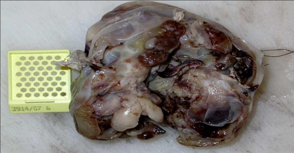 teratoma Pathologiai diagnosis: bizonytalan