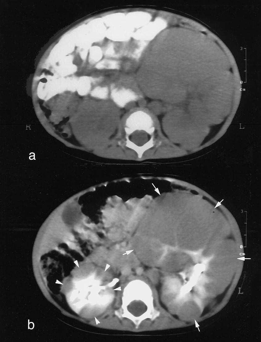 vesekéreghez - UH, CT, MR - kontrasztanyag után CT-n hypodenz,