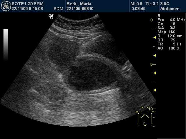 Az uterus, vagina obstructio miatt