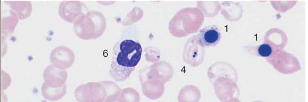 Hemoglobinopátiák Thalassemia major