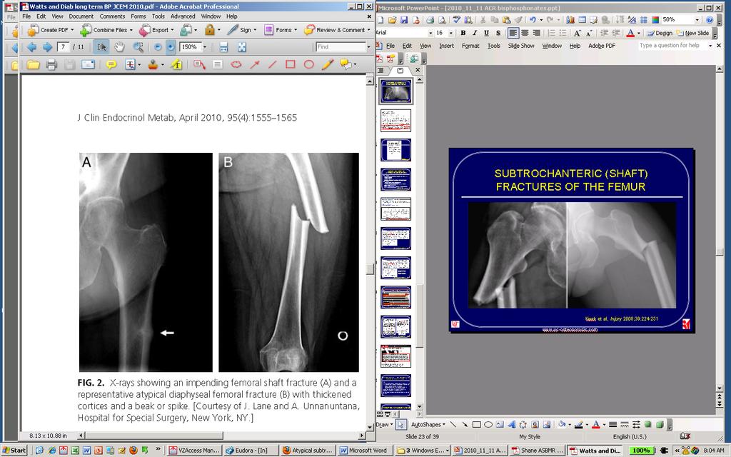 Atípusos femur törés hosszútávú antireszorptív kezelésnél May begin with stress reaction or stress fracture of lateral femoral cortex (A) Transverse fractures of femoral diaphysis or in