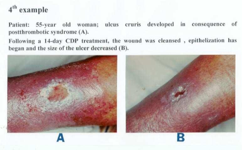 Beteg: 55 éves asszony, postthrombotikus szindroma következtében kialakult ulcus cruris (A) 14