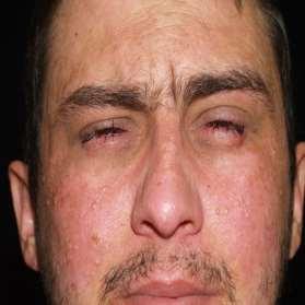 Ocular Stevens-Johnson