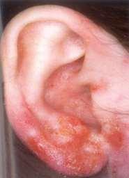 Kontakt dermatitis