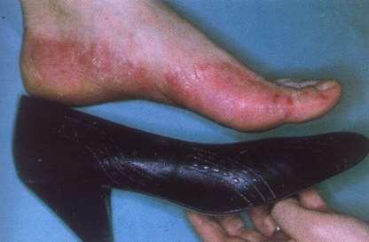 kontakt dermatitis