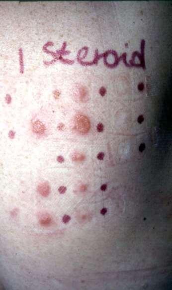 Steroid kontakt dermatitisz edge effect Magas allergén potenciál: tixocortol pivalat budenosid (Apulein) prednicarbat a steroid allergiások 90%-ban lehet vele az allergiát detektálni
