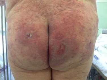 1 ampulla Augmentin i.