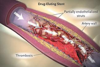 Stent thrombosis (ST) stratifikáció ST: